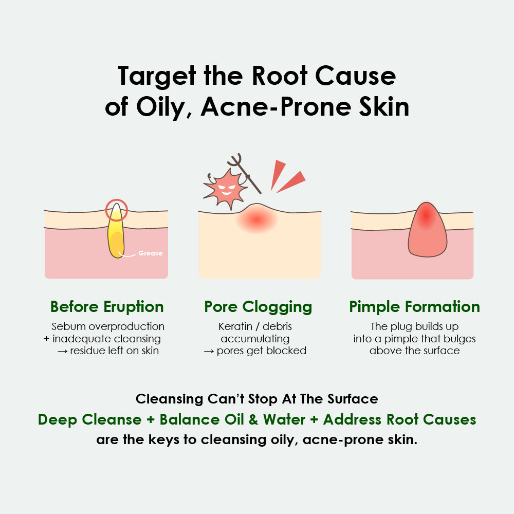 Winona Acne Free Cleansing Foam 80g