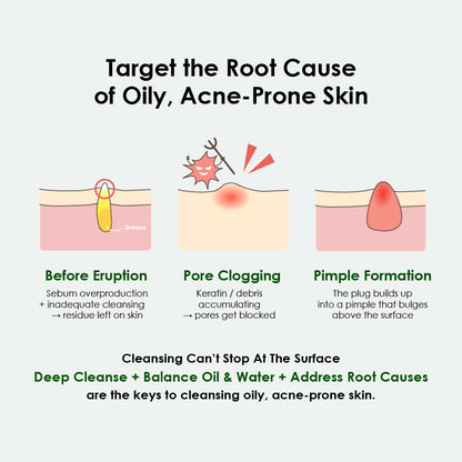 Winona Acne Free Cleansing Foam 80g